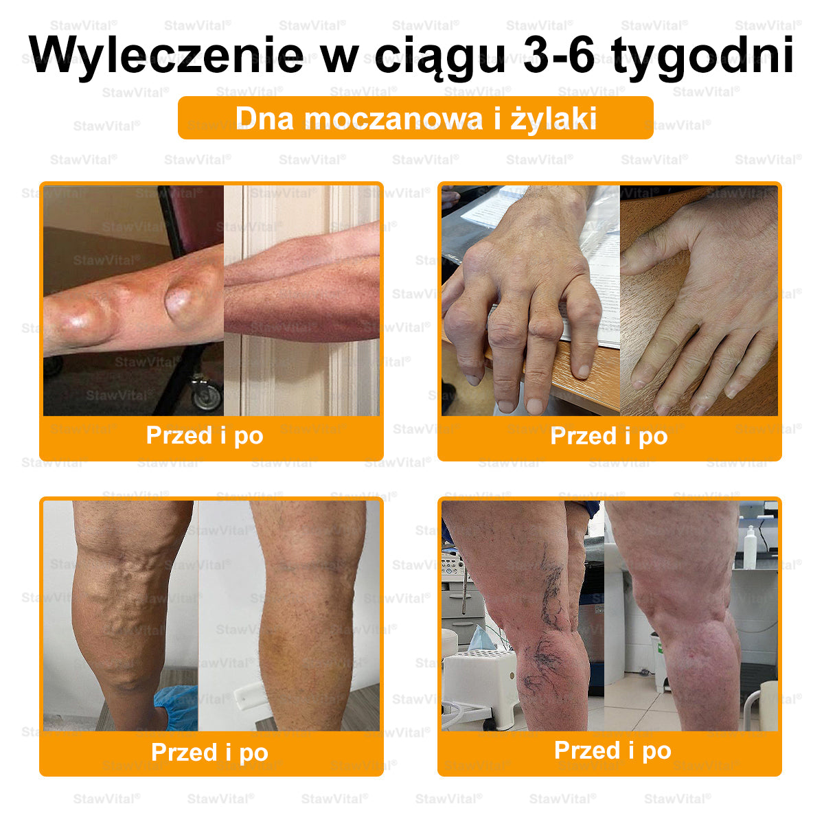 🎉🎉🎉Gratulacje! Jesteś w gronie pierwszych 200 zamówień! Skorzystaj z dodatkowego rabatu 50%! Działaj teraz, aby utrzymać zdrowie swoich stawów. Jeśli przegapisz tę okazję, będziesz musiał/a czekać do przyszłego roku!