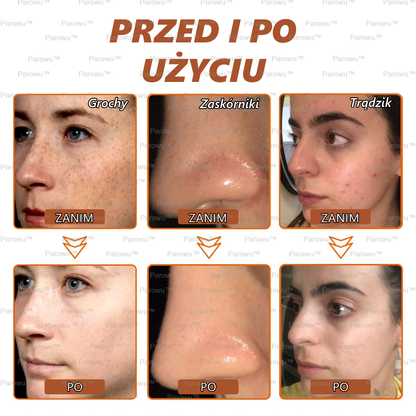 Parowu™ Wybielająca i Rozjaśniająca Maska ✅- Naturalne składniki trwale usuwają plamy, piegi i przebarwienia🔥🔥
