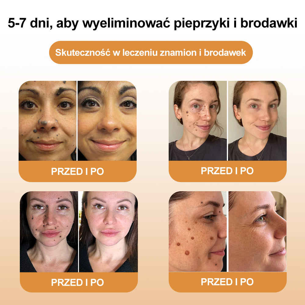 🍃🍃[✨Oficjalny sklep markowy✨] krem XRLXRL™ PSZCZOŁA JAD do usuwania brodawek i pieprzyków(👨‍⚕️PTD AJÁNLJA)