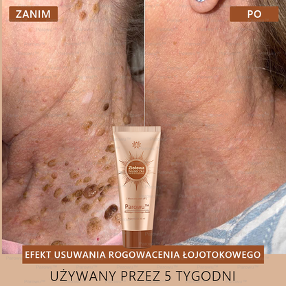 Parowu™ Wybielająca i Rozjaśniająca Maska ✅- Naturalne składniki trwale usuwają plamy, piegi i przebarwienia🔥🔥