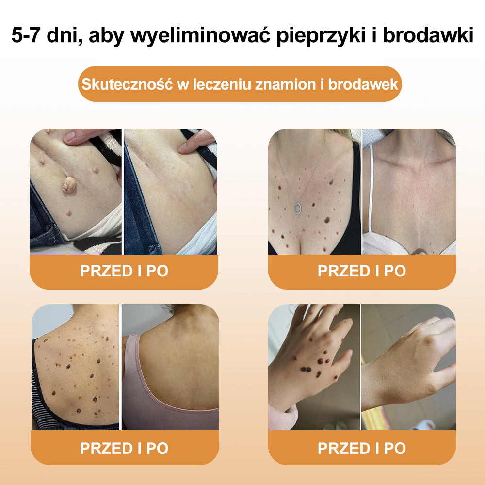 ⭐⭐⭐⭐⭐[✨Oficjalny sklep markowy✨] krem XRLXRL™ PSZCZOŁA JAD do usuwania brodawek i pieprzyków(👨‍⚕️PTD AJÁNLJA)