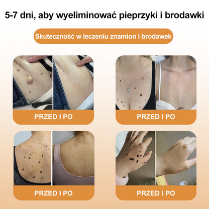 🔥🔥[✨Oficjalny sklep markowy✨] krem XRLXRL™ PSZCZOŁA JAD do usuwania brodawek i pieprzyków(👨‍⚕️PTD AJÁNLJA)