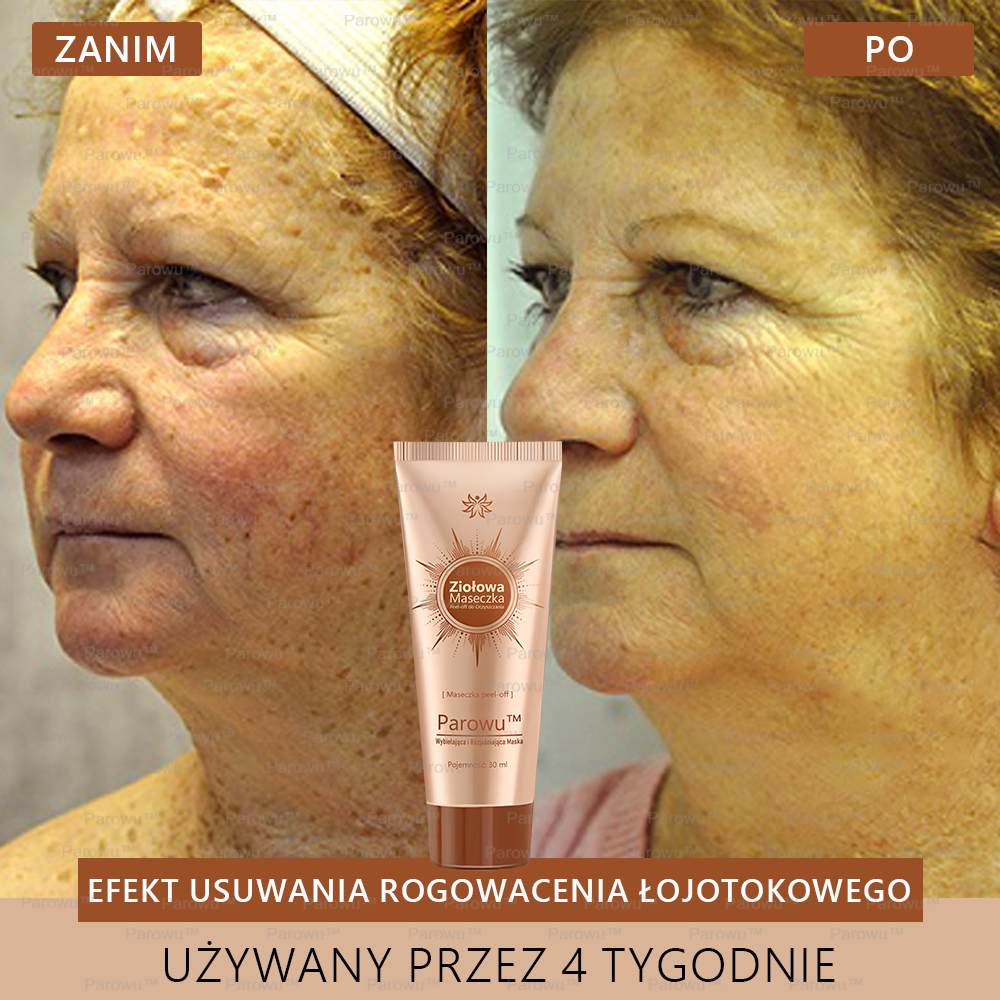 Parowu™ Wybielająca i Rozjaśniająca Maska ✅- Naturalne składniki trwale usuwają plamy, piegi i przebarwienia🔥🔥