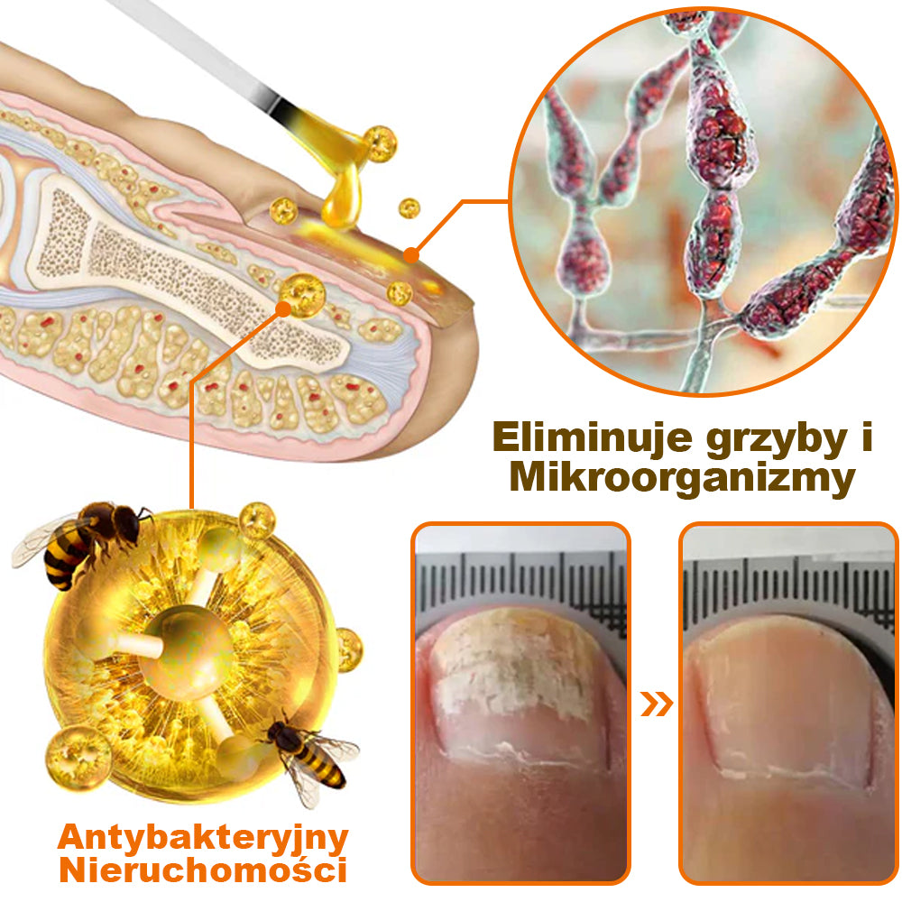 [✨Oficjalny sklep markowy✨]PaznokciVital™ Serum do paznokci FungiFree z jadem pszczelim